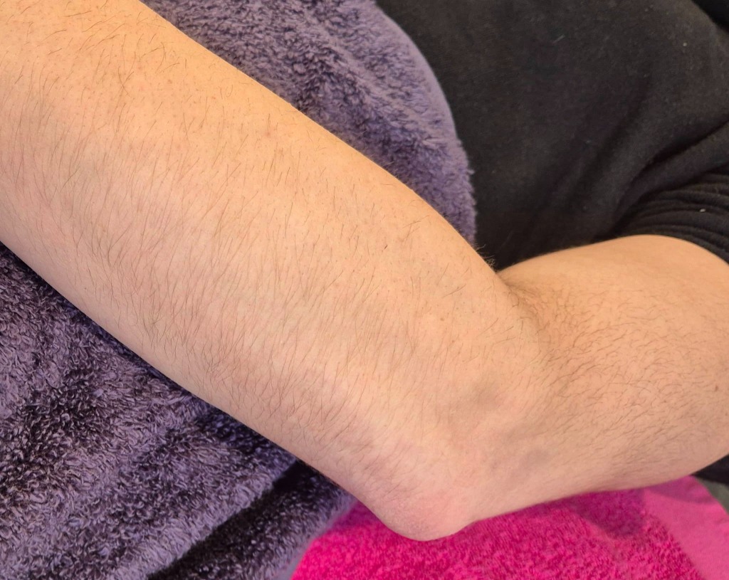 Waxing Before Treatment - Natural Arm Hair